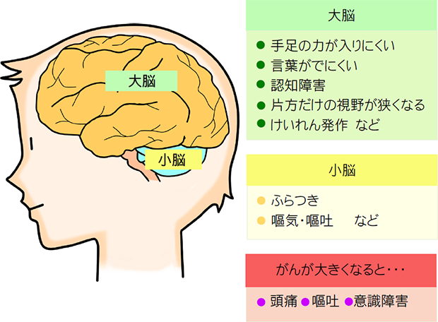 大脳:手足の力が入りにくい 言葉がでにくい 認知障害 片方だけの視野が狭くなる けいれん発作 など／小脳：ふらつき 嘔気・嘔吐 など／がんが大きくなると・・・：頭痛 嘔吐 意識障害