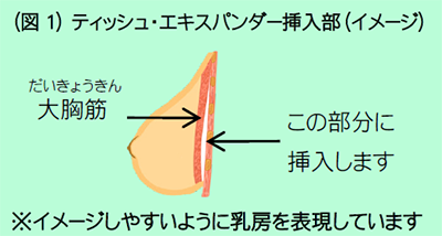 (図1) ティッシュ・エキスパンダー挿入部（イメージ）