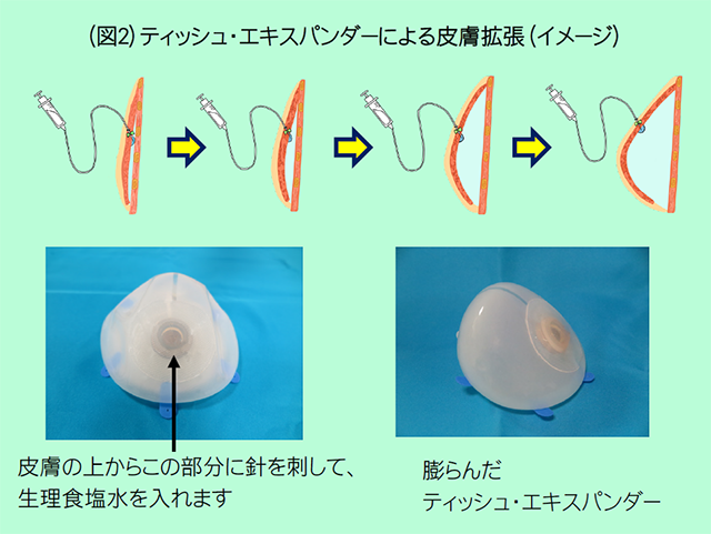 （図２）ティッシュ・エキスパンダーによる皮膚拡張（イメージ）