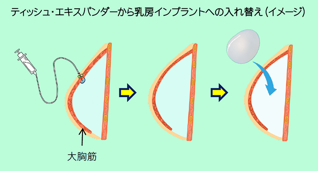 ティッシュ・エキスパンダーから乳房インプラントへの入れ替え（イメージ）