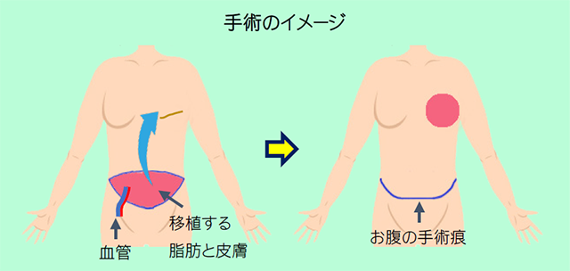 手術のイメージ