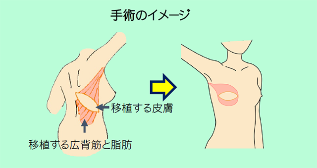 手術のイメージ