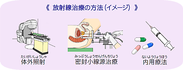 放射線治療の方法（イメージ）