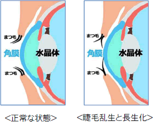 睫毛乱生のイラスト